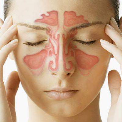 Migraine sinusite