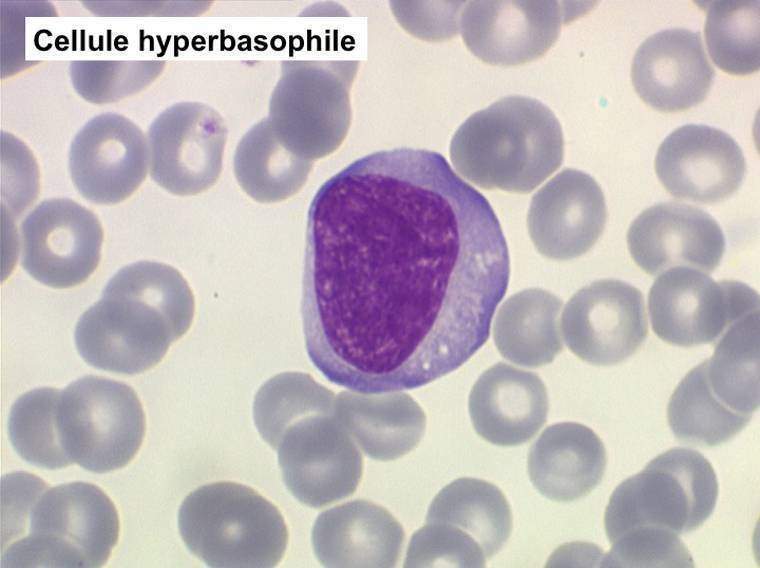 Mononucléose infectieuse