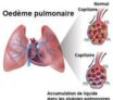 Œdème pulmonaire, œdème aigu du poumon , œdème aigu pulmonaire ou eau dans les poumons