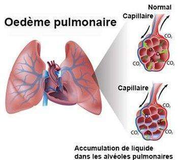 Œdème pulmonaire, œdème aigu du poumon , œdème aigu pulmonaire ou eau dans les poumons