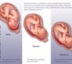 Placenta prævia