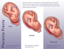 Placenta prævia