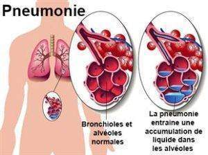 Pneumonie traitement