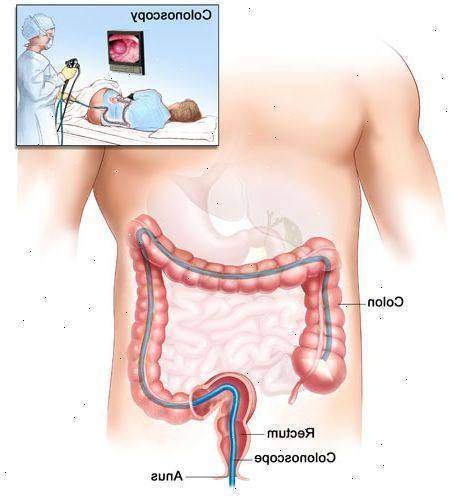 Polype colon