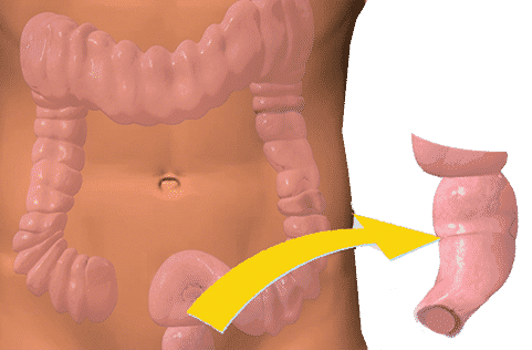 Cancer du rectum