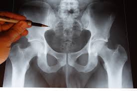 Radiographie