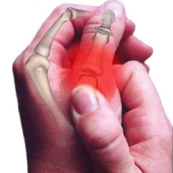 Rhumatisme arthrose