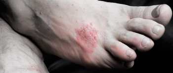 Rhumatisme psoriasis