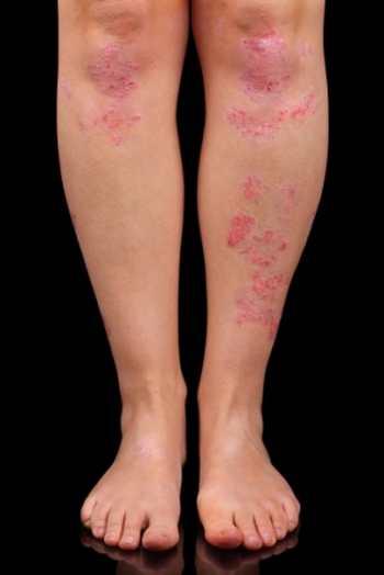 Rhumatismes psoriasiques