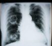 Symptome cancer du poumon
