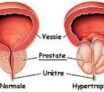 Symptomes cancer prostate