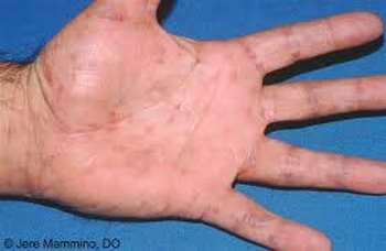 Syphilis