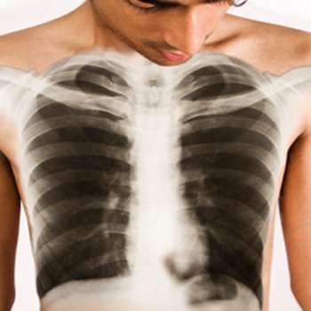 Tuberculose