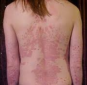 Types de Psoriasis