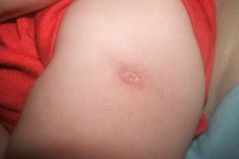 Vaccin tuberculose