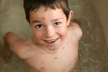 Varicelle enfants