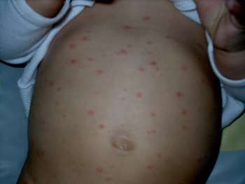 Varicelle grossesse