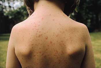 Varicelle herpes