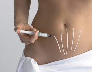 Vergetures grossesse