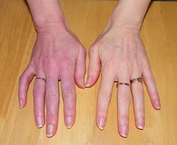 Traitement algodystrophie