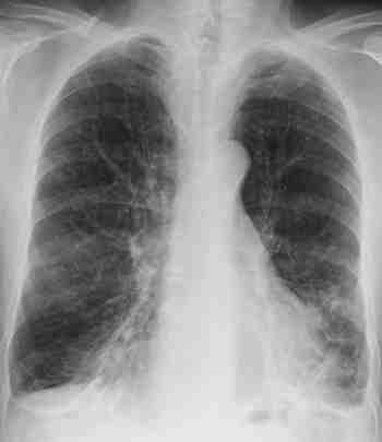 Dilatation des bronches