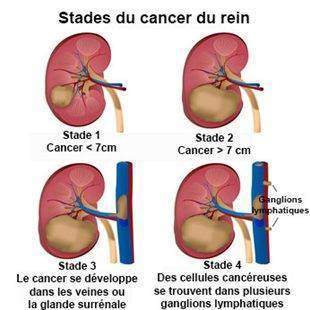 Tumeur reins