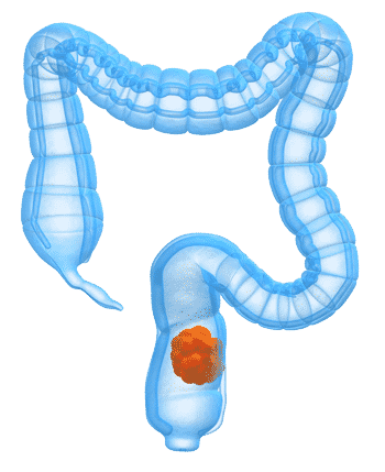 Cancer colorectal