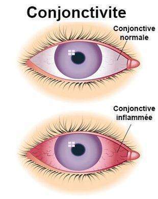 Traitement conjonctivite