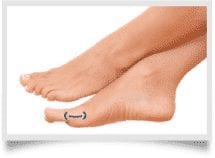 Chirurgie hallux valgus