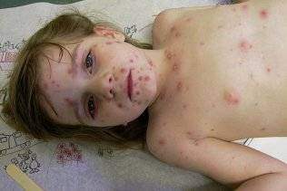 Varicelle enfant