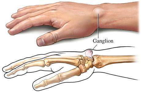 Ganglion