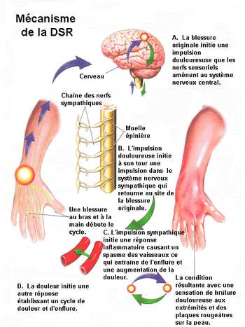 Algodystrophie