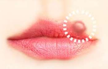 L’herpès labial