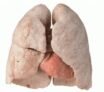 Cancer des poumon