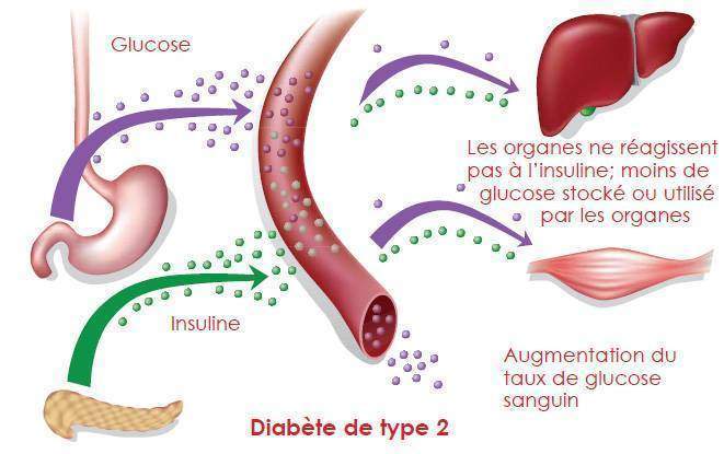 Diabète de type 2