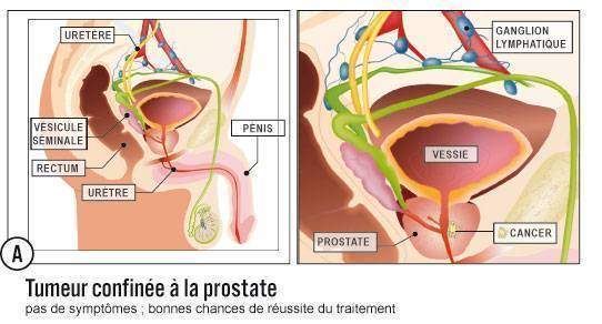 Symptômes de la prostate