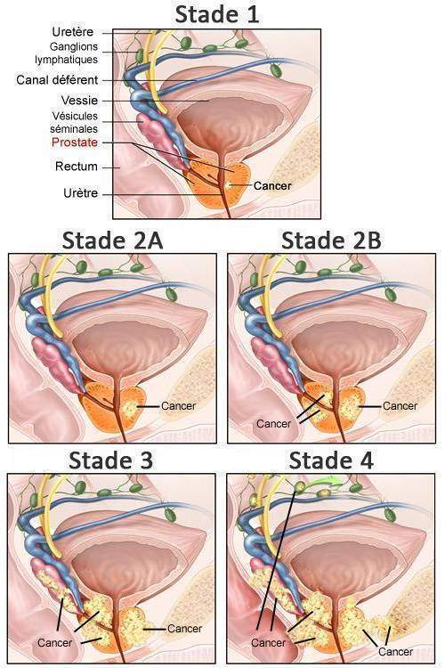 Tumeur prostate