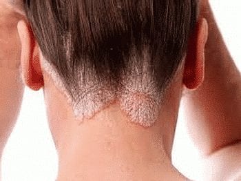 Comment soigner le psoriasis