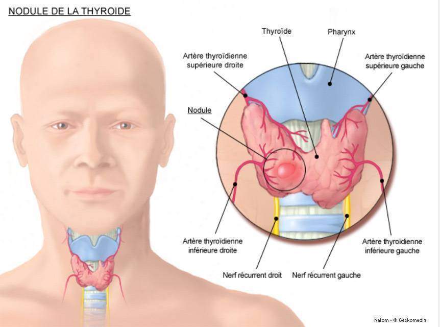 Traitement hyperthyroïdie