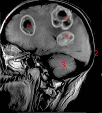 Abcès du cerveau