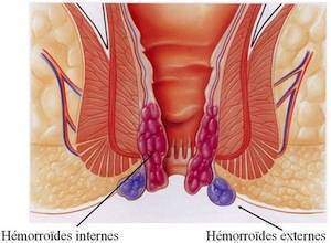 Affection de la région anale