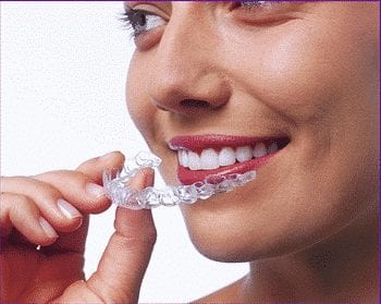 L'orthodontie adulte a fait beaucoup de progrès mais reste gênante