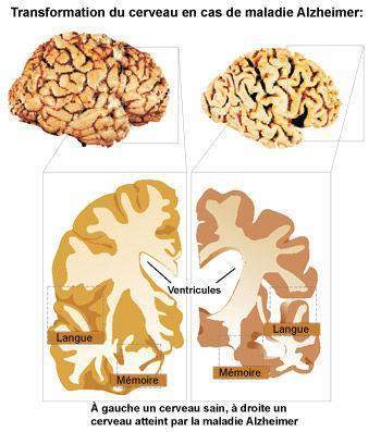 La psychopathologie du vieillissement : les démences de type Alzheimer