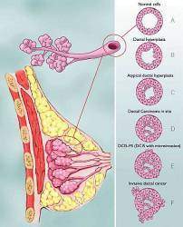 Le cancer du sein :  La propagation des cancéreuses