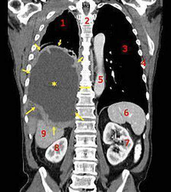 Le cancer du sein : typologie et classification des cancers