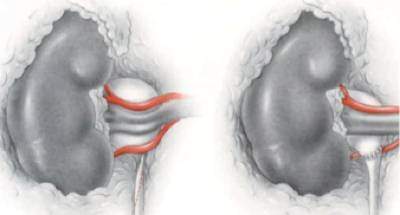 Le syndrome de la jonction pyelo-ureterale