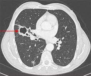 Pathologie bronchique