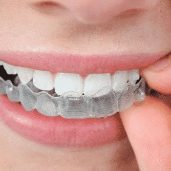 Une belle denture revient chère