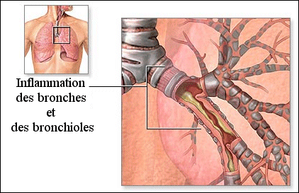 Allergie : L' inflammation des bronches