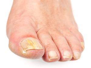 Mycoses des ongles